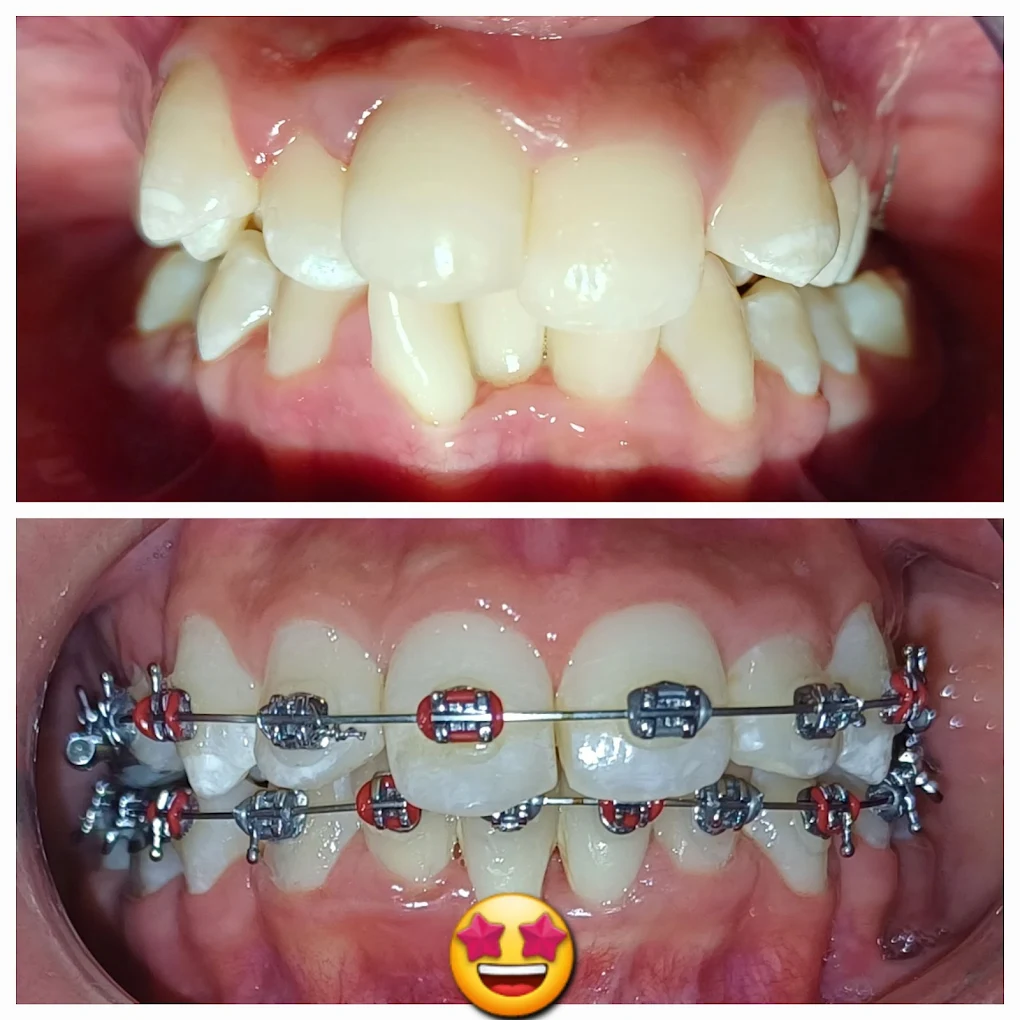 Resultado de brackets metálicos: antes y después