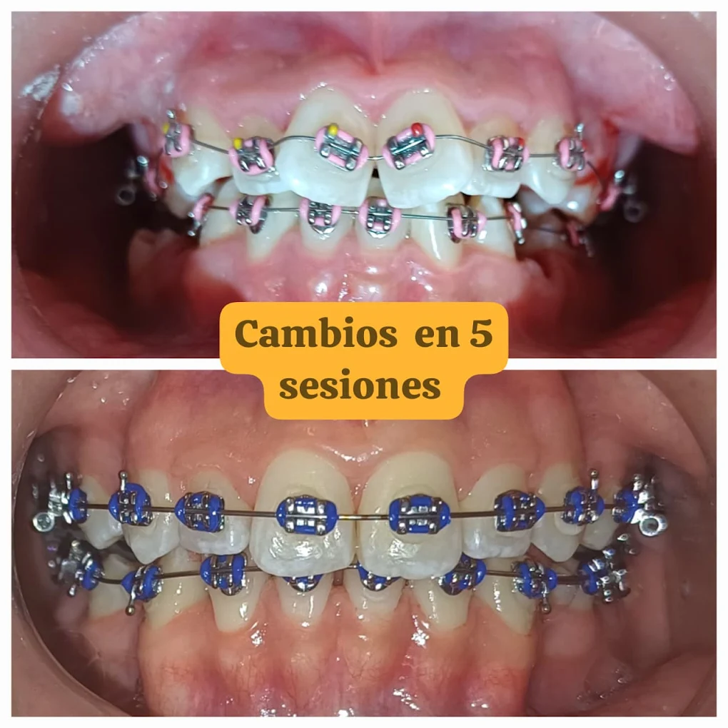 Resultados de ortodoncia: cambios visibles en 5 sesiones
