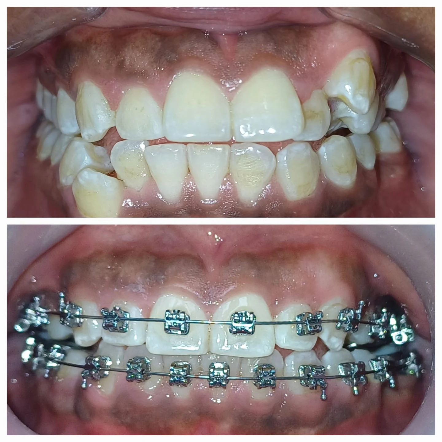 Caso real: retratamiento de ortodoncia con brackets autoligables, antes y evolución