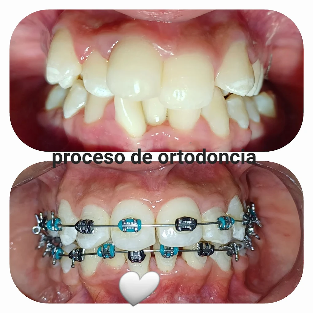 Proceso de ortodoncia con brackets: antes y después