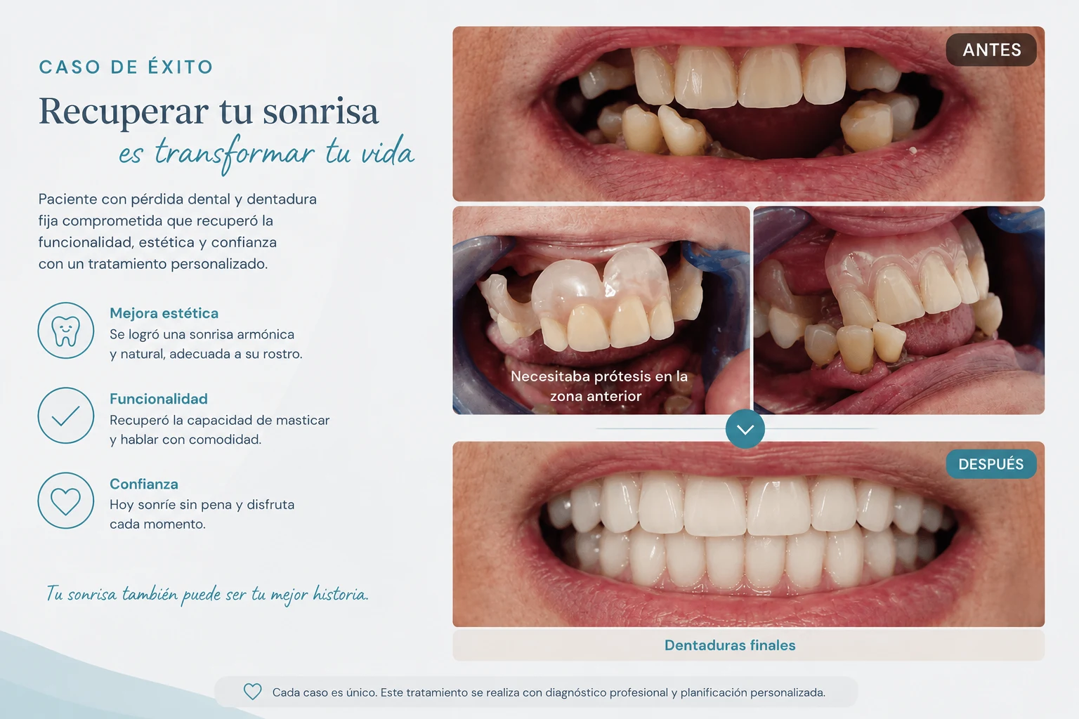 Caso de rehabilitación oral: restauración de dentadura, antes y después