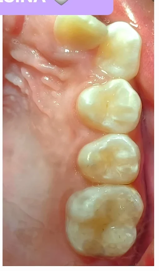 Rehabilitación de molar con resina: resultado final
